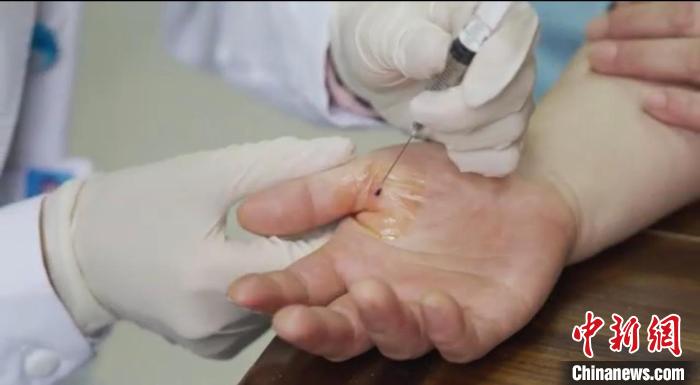 嘉善群眾體驗(yàn)小針刀?！〖紊平y(tǒng)戰(zhàn) 供圖