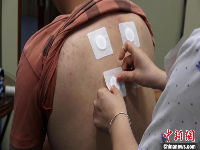 圖為醫(yī)生正在為民眾貼“三伏貼”?！√莆登?攝